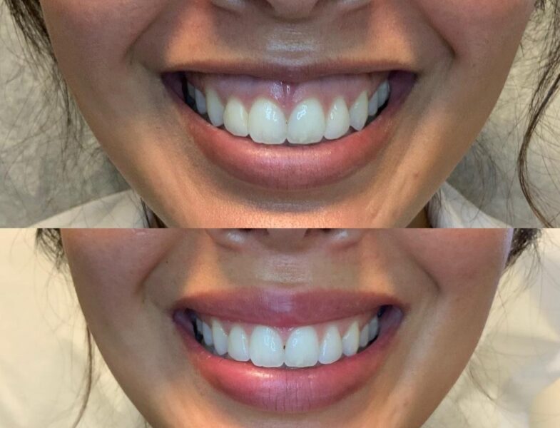 lip flip before and after